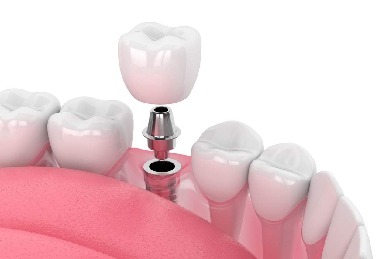 ¿Los implantes duran para siempre?¿Qué cuidados necesitan? Profesionales de Helident Training Center