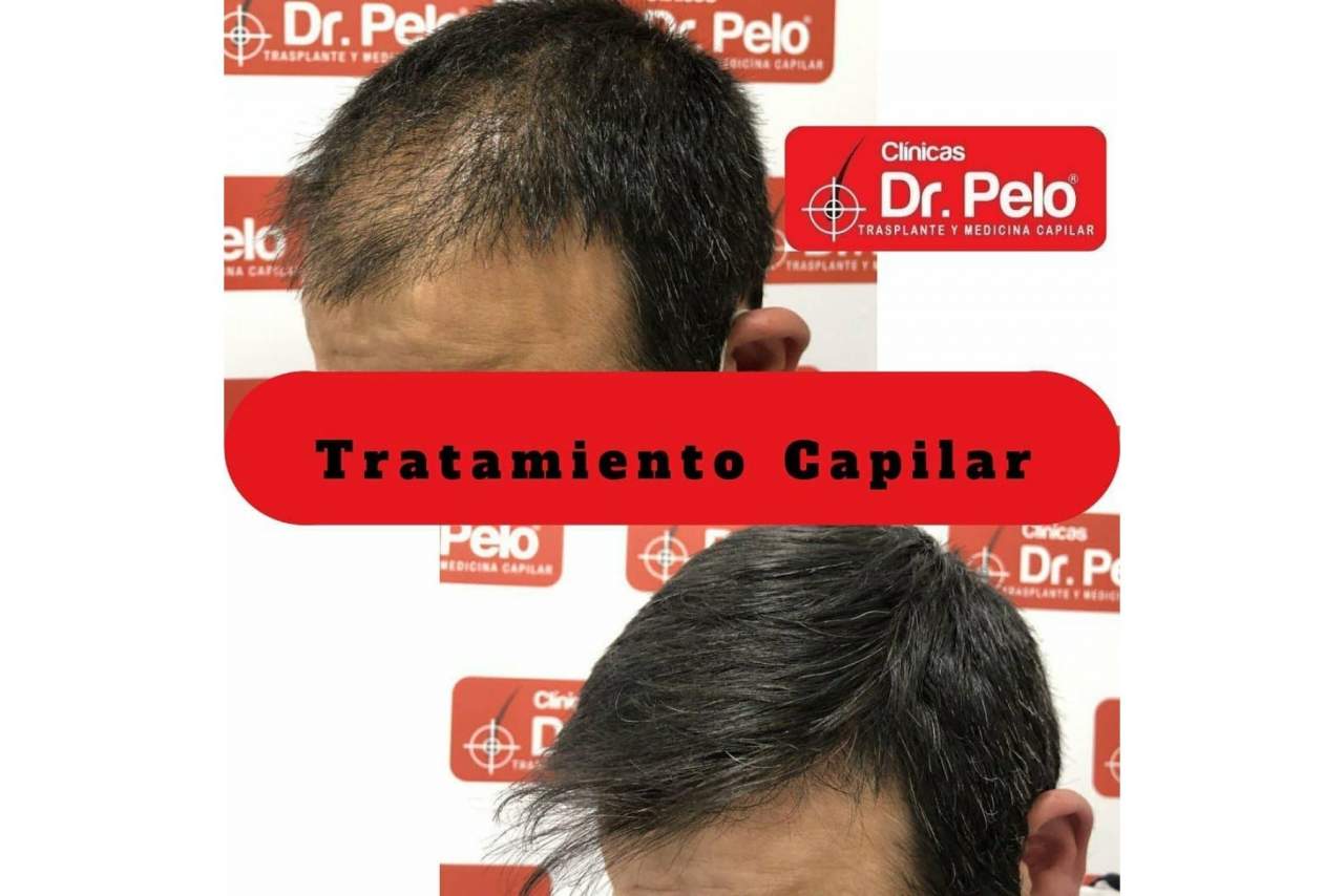 El trasplante capilar en España gana popularidad en los últimos años tras mejorar los precios y las técnica aplicadas