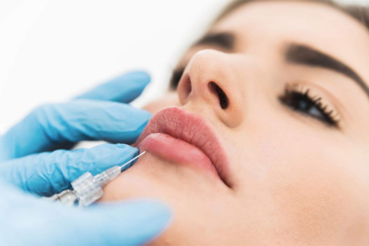 Clínica Dr. Zito: Aumento de labios con ácido hialurónico
