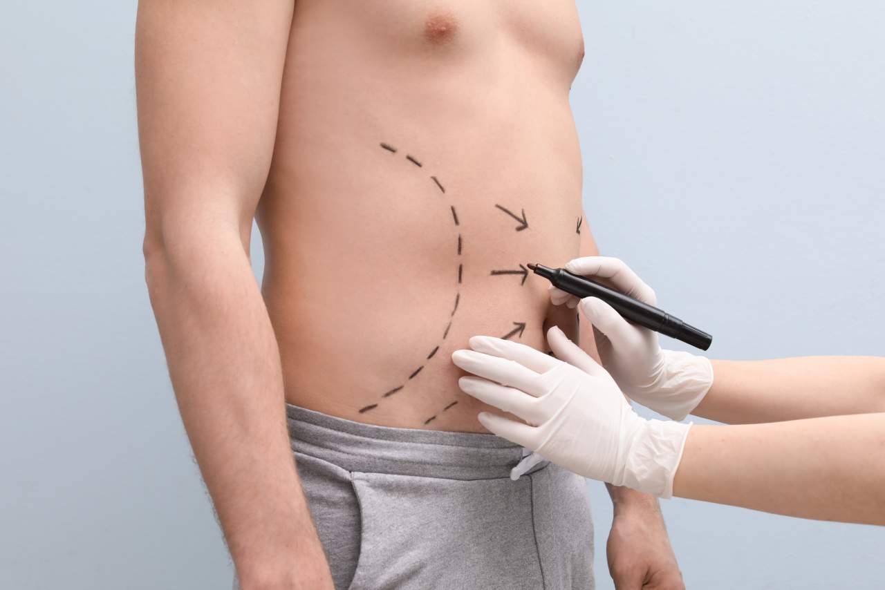 Tratamiento estrella en 2021: eliminar la grasa localizada mediante la mesoterapia corporal