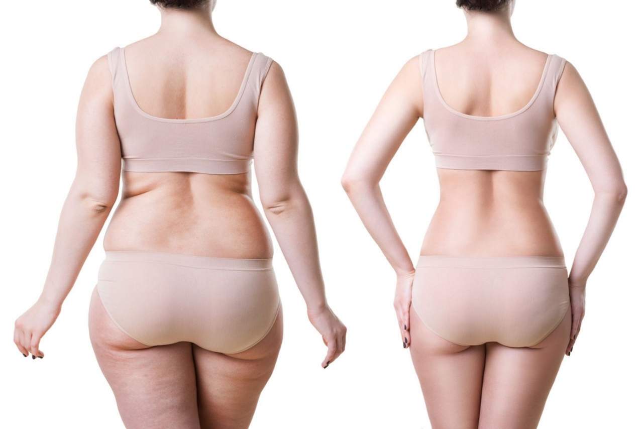 Hidrolipoclasia 4D antes y después: la Clínica Ciscar ofrece este tratamiento que permite eliminar grasa localizada