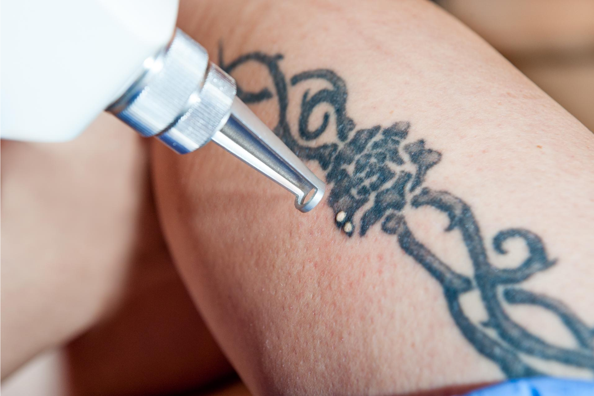 Bodyslim: Yag Láser para eliminar tatuajes