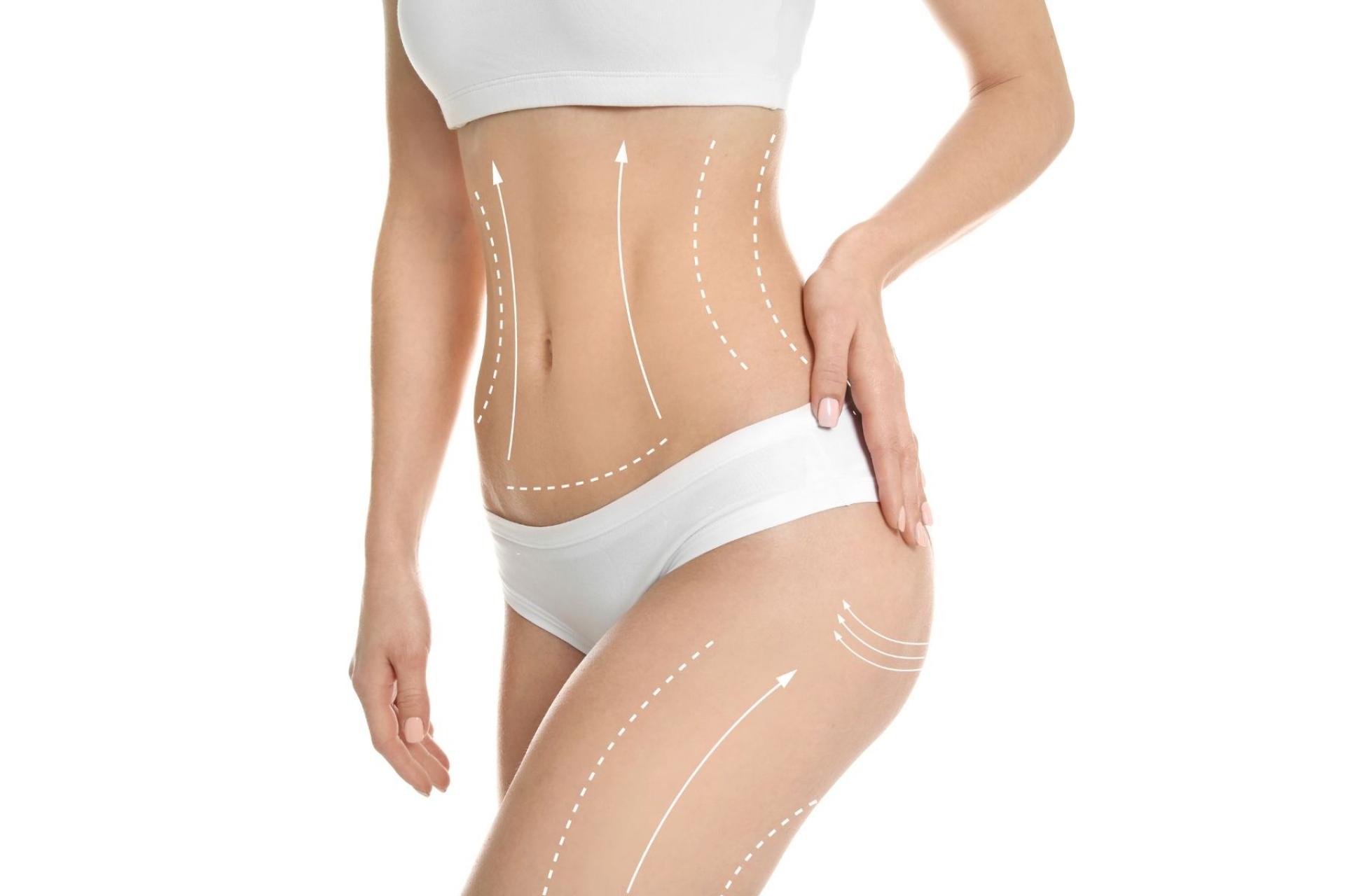 Tratamiento corporal TightSculpting realizado por la Clínica Fercasy