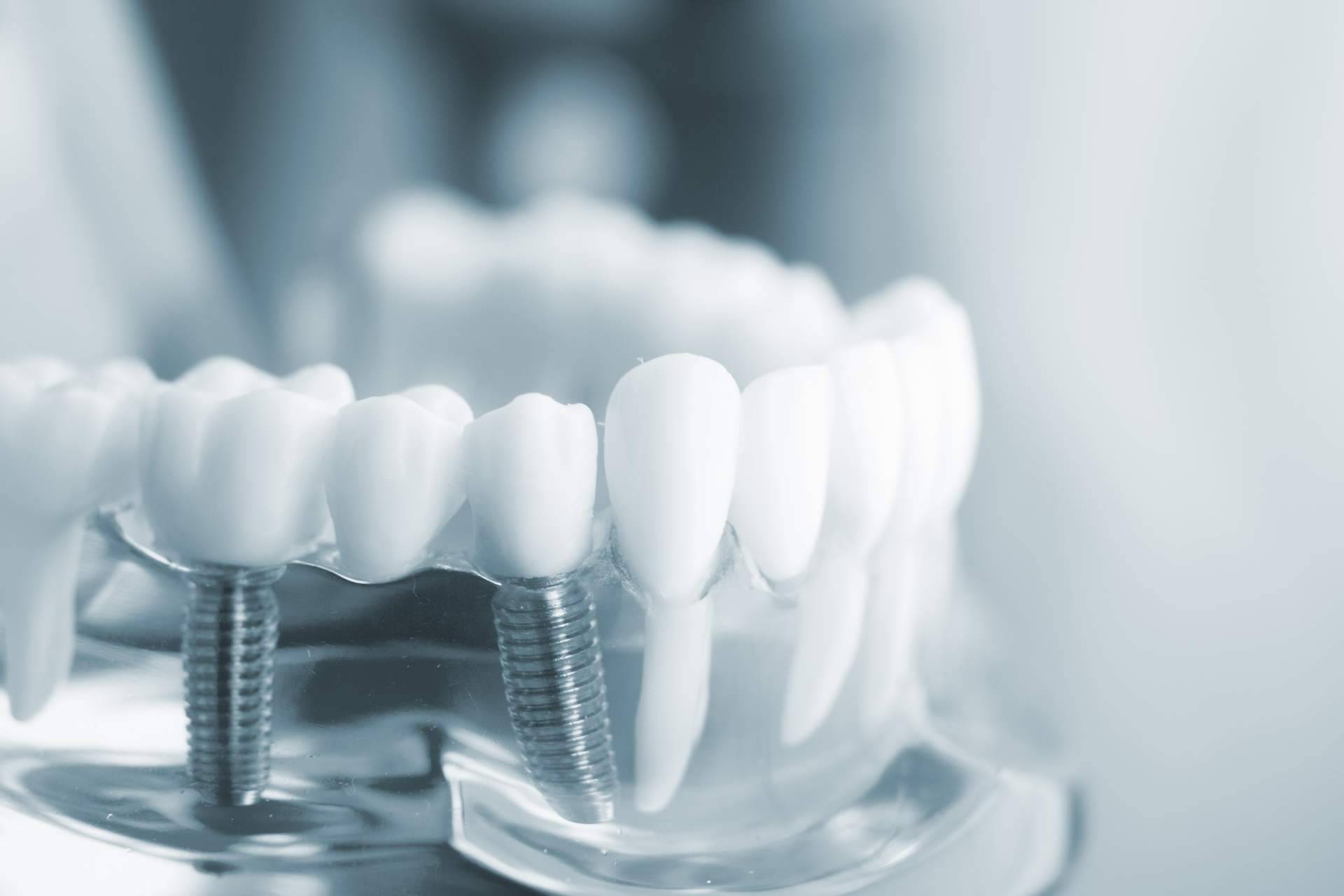 Clínica Artydents en Madrid logra conseguir dientes fijos en un solo día gracias a los implantes dentales de titanio V