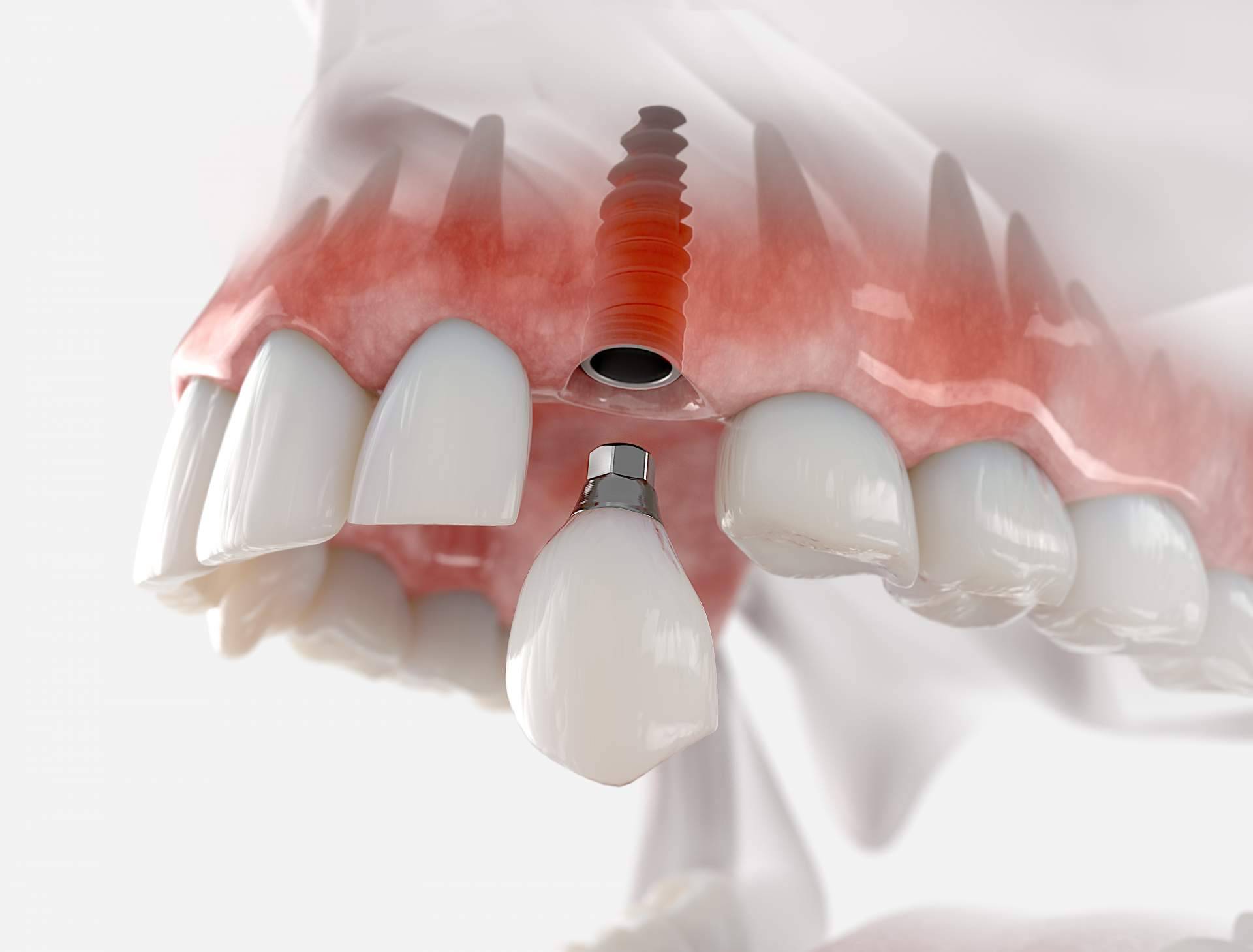 ¿Por qué es tan exitoso el implante dental de titanio V de la Clínica Artydents en Madrid?