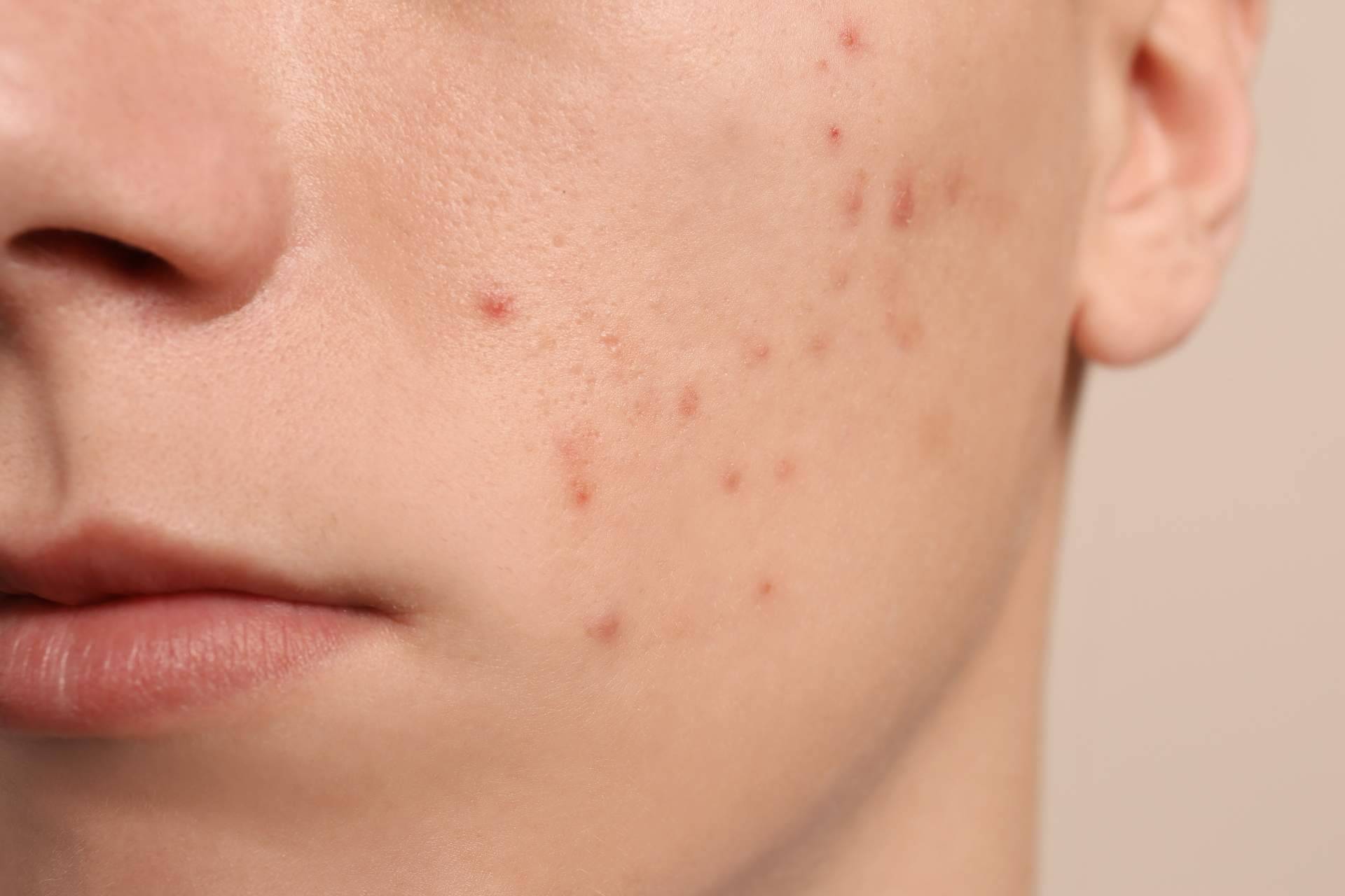 AcnéXero, la app de inteligencia artificial fundada por dos dermatólogos que permite terminar con las espinillas y el acné
