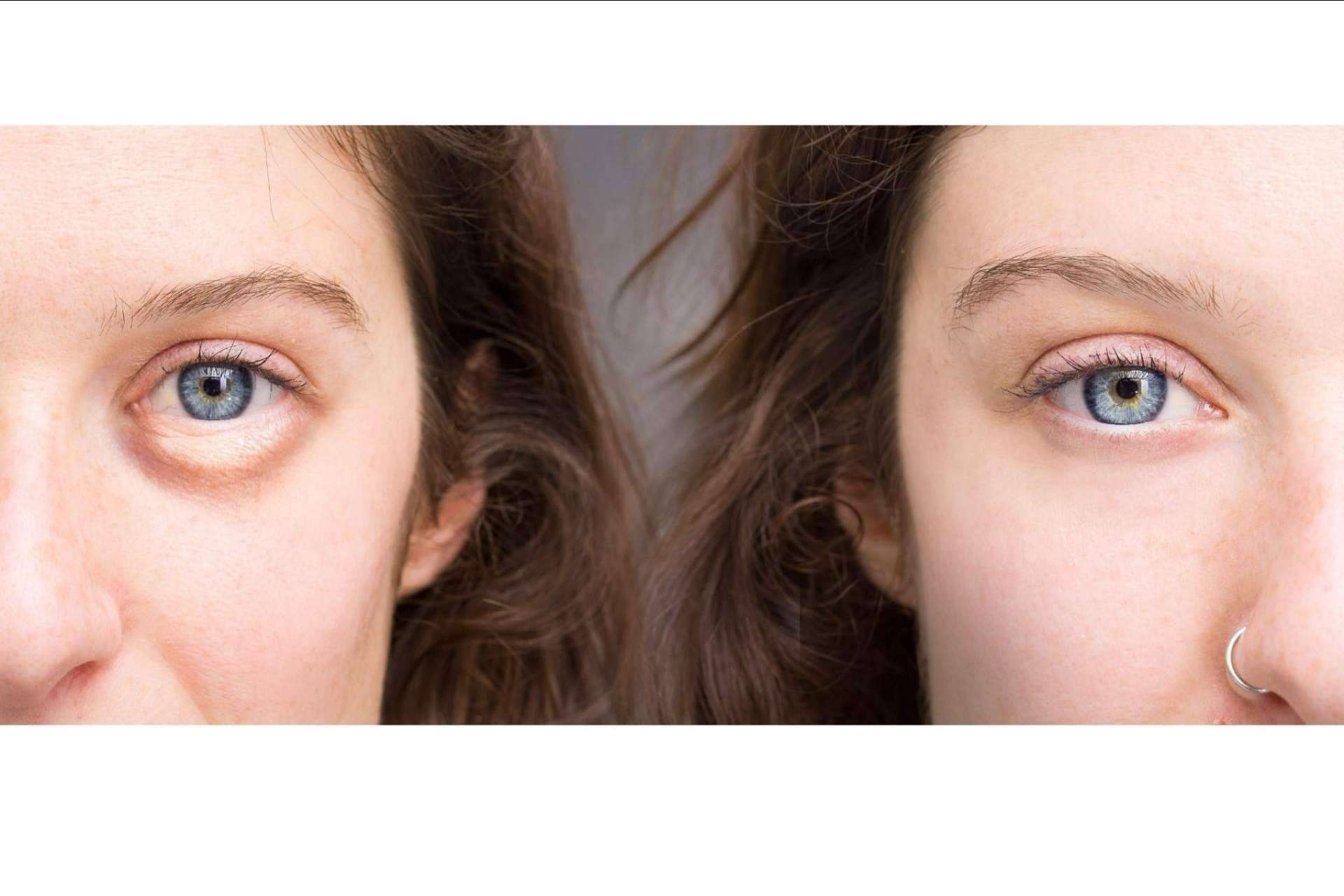 Ácido hialurónico para combatir las ojeras: Unidad de medicina estética FEMME de Santiago de Compostela con la Dra. Alfonsina Uriburu