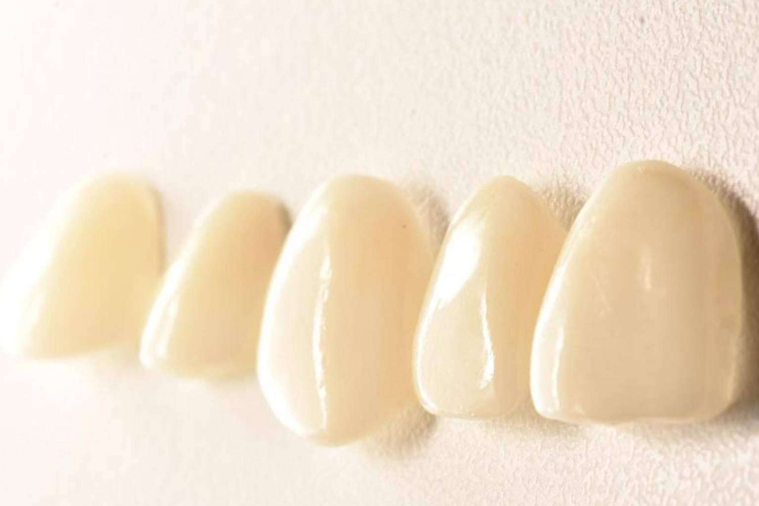 Tener una sonrisa perfecta con tratamientos 0 invasivos es posible con las carillas Emax y las inyectadas de composite de Implant Clinics