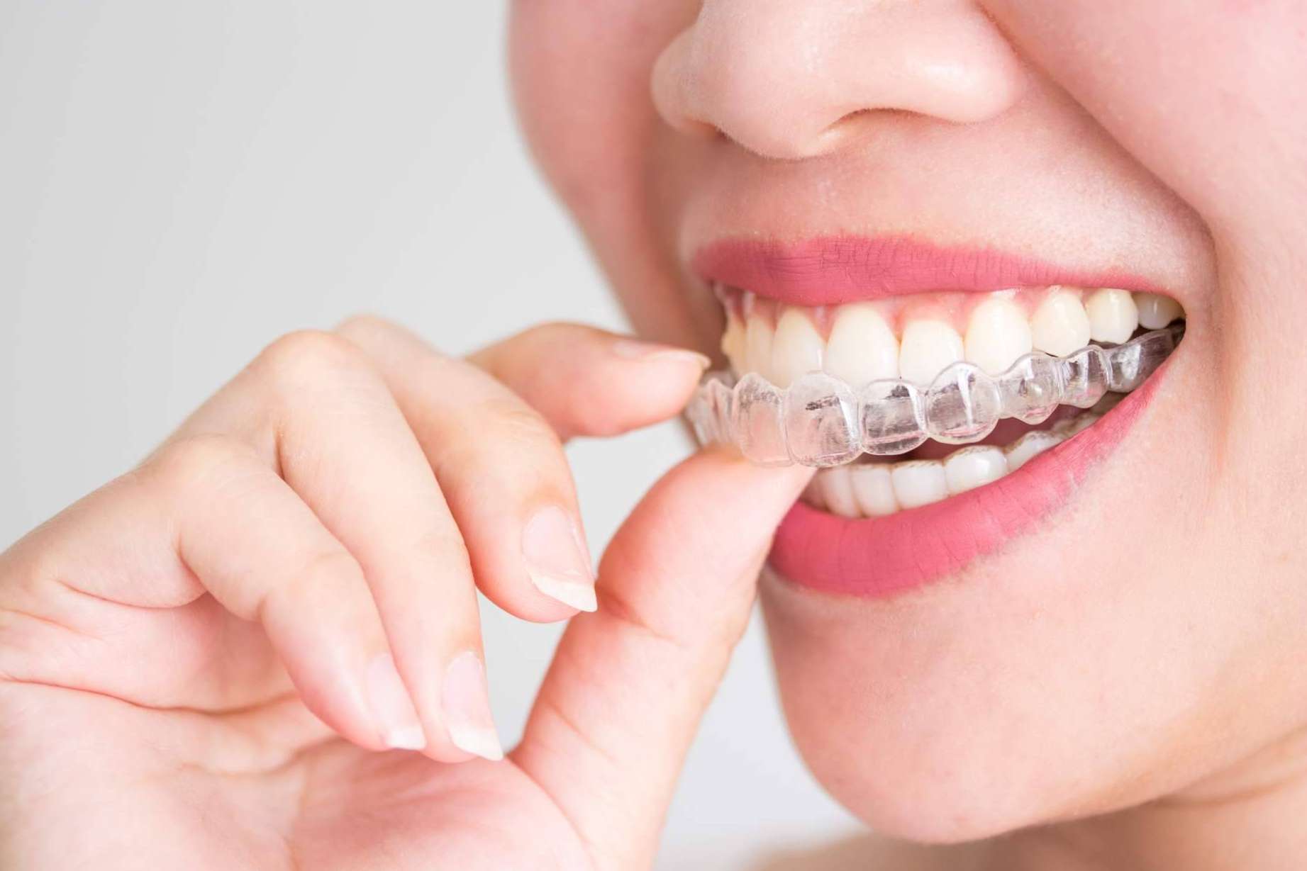 Helident Clínica Dental ofrece tratamiento de ortodoncia con brackets
