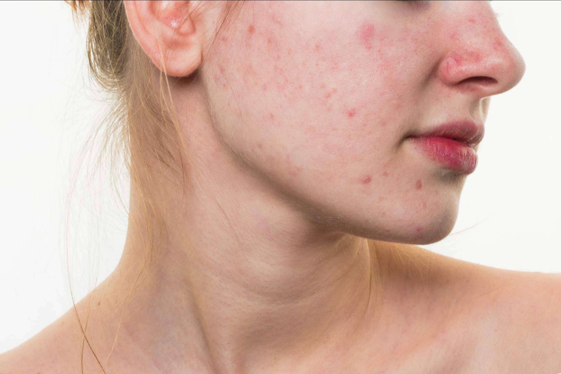 AcnéXero, la aplicación fundada por dermatólogos que propone soluciones efectivas contra el acné