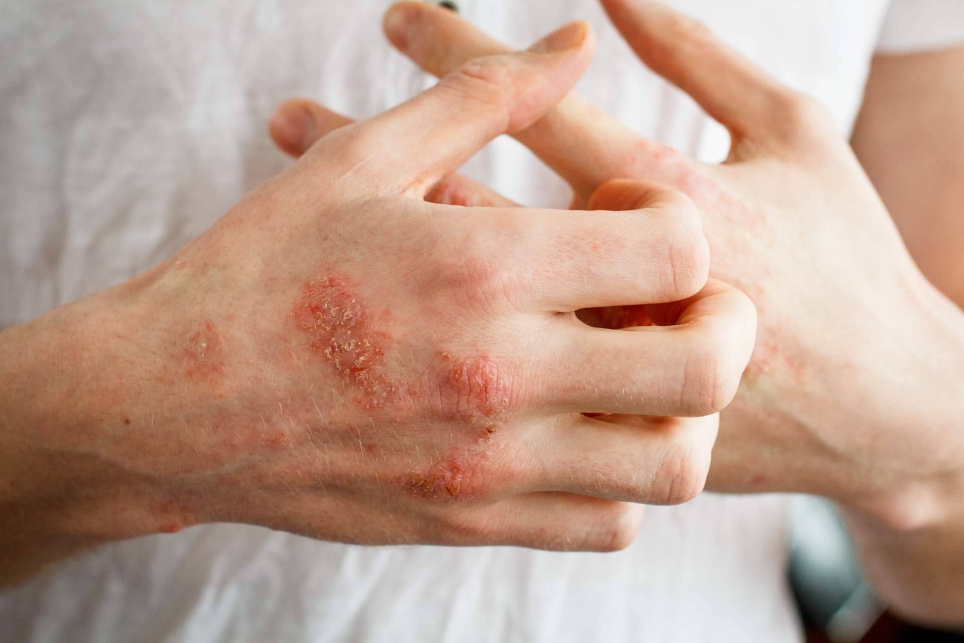 ¿Cómo se diferencia un eczema de contacto de un eczema atópico?, por Laboratorio Géomer