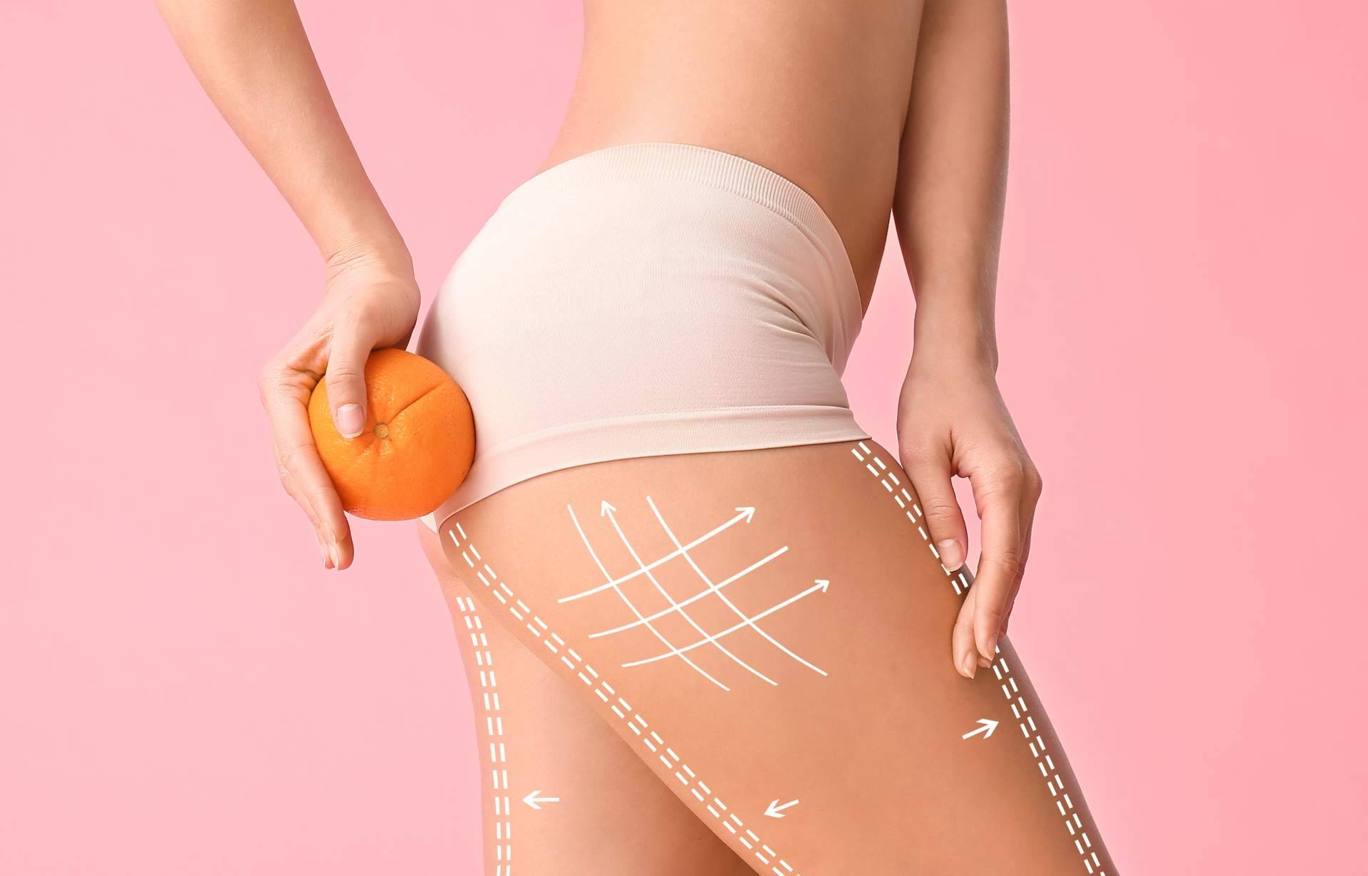 6 acciones para combatir la celulitis, por el Laboratorio Géomer