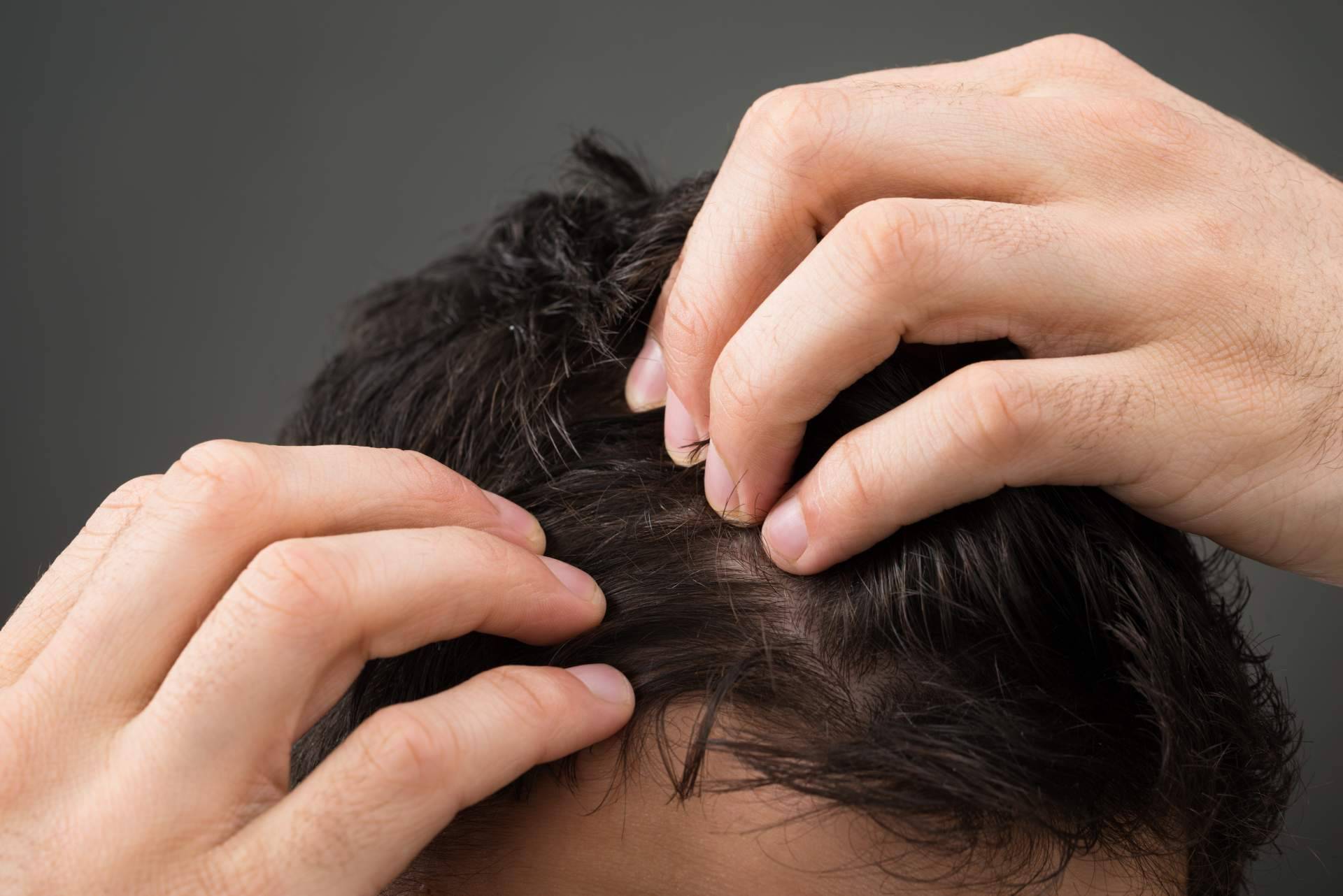 Los diferentes tipos de caídas del pelo, por el Laboratorio Géomer