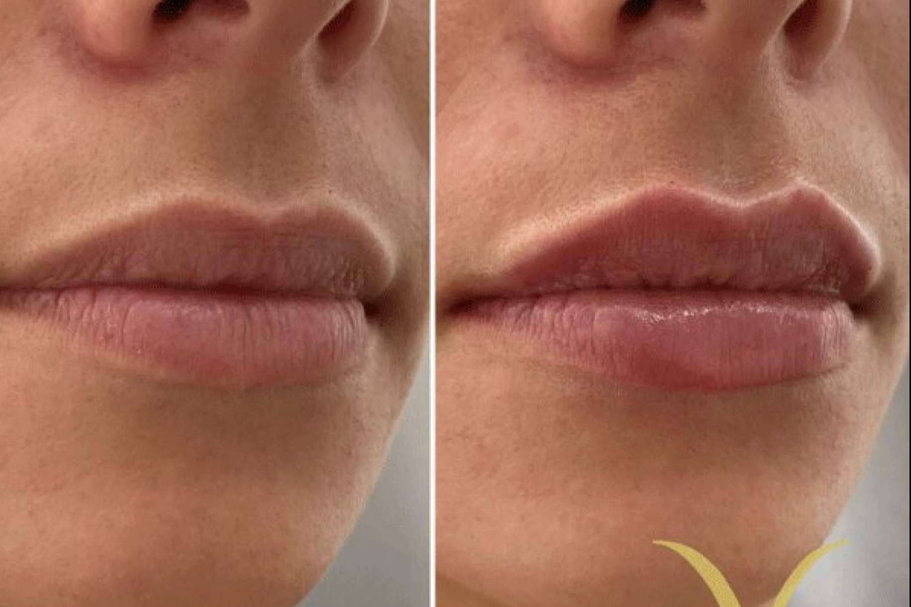 La técnica, Adiblips, de la Clínica Yasmin para el aumento de labios con ácido hialurónico