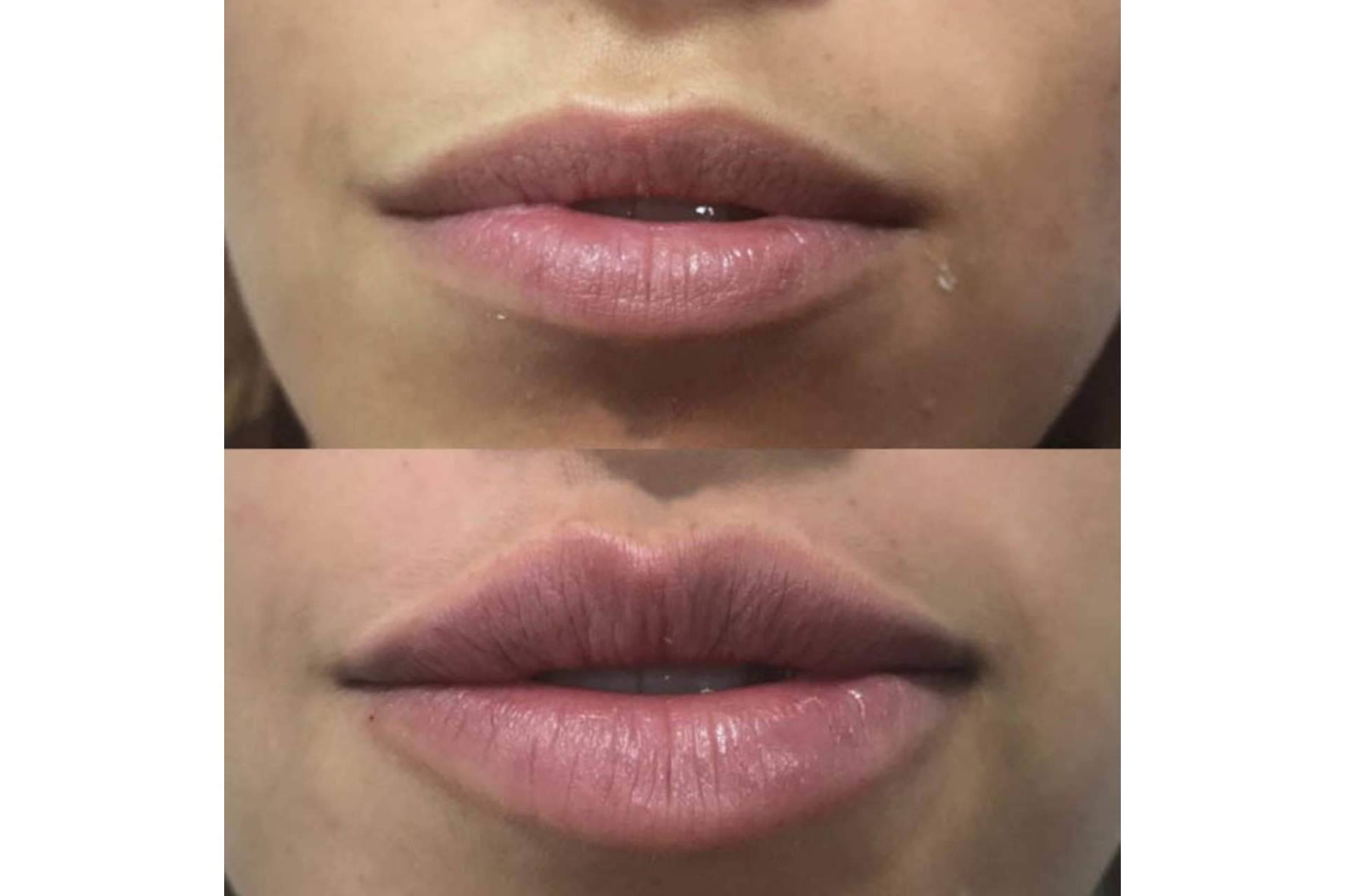 ¿Es posible realizarse un aumento de labios en Madrid con resultados naturales?, por la Dra. Cecilia Arthur