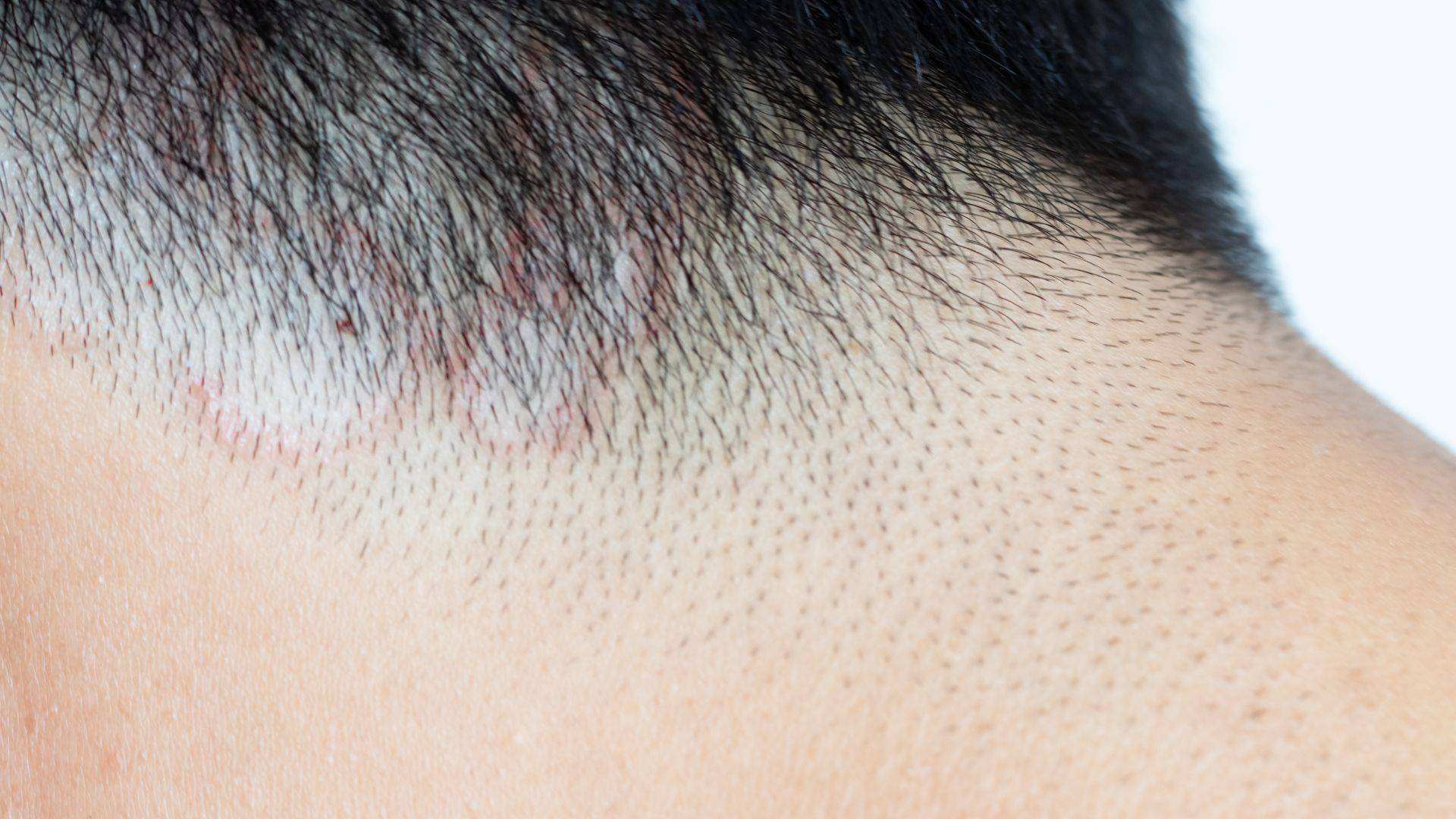 Alopecia por tiña del cuero cabelludo, ¿pueden contagiar los perros?