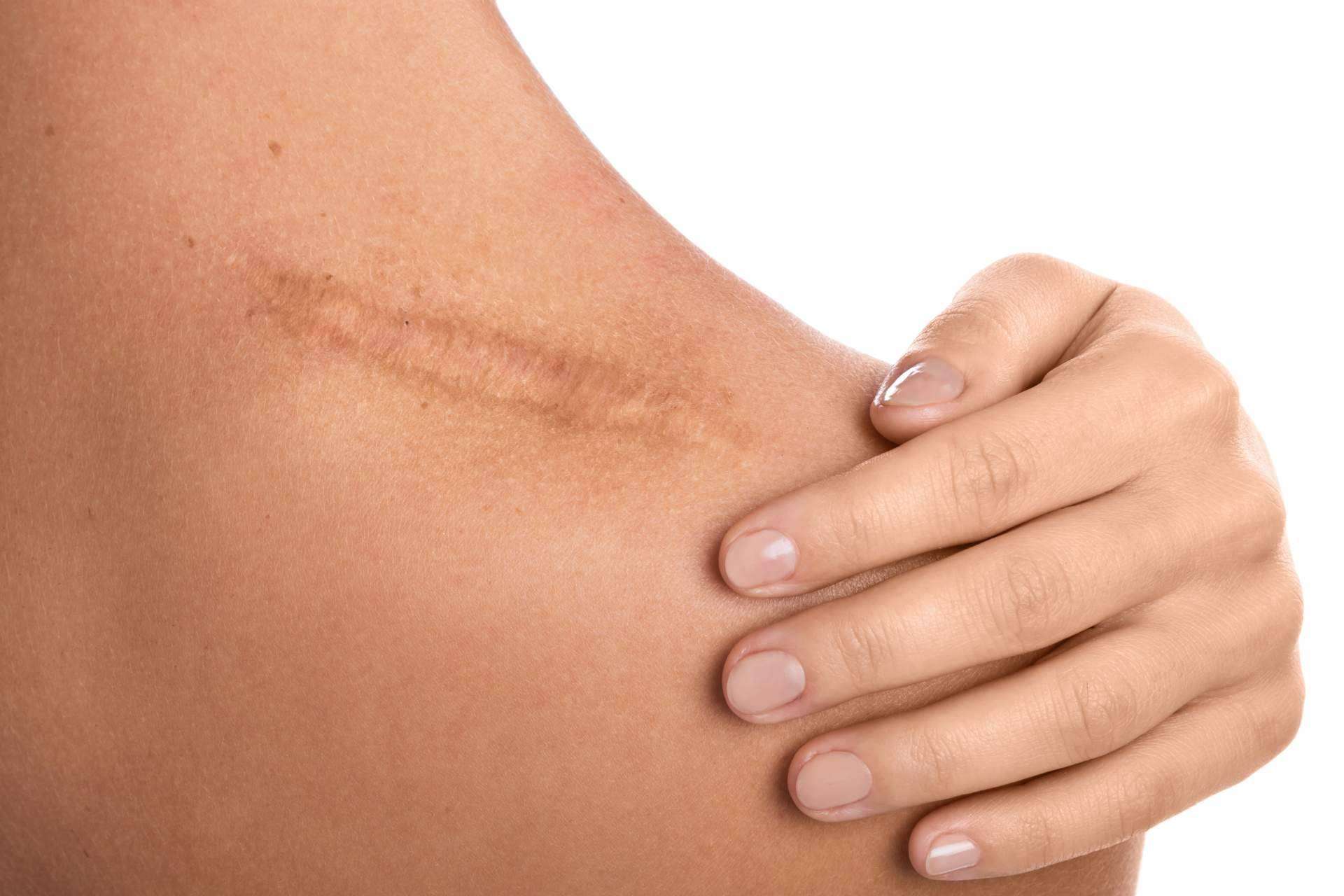 ¿Cómo cuidar las cicatrices en la piel de cara al verano?, por los expertos de La Parafarmacia del Puerto
