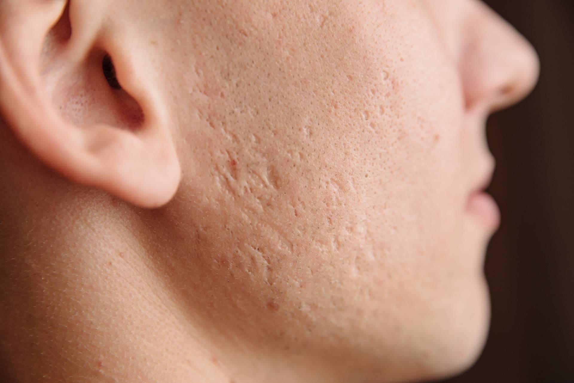 Tratamiento de cicatrices de acné con radiofrecuencia fraccionada con microagujas, en Alluring Clinic