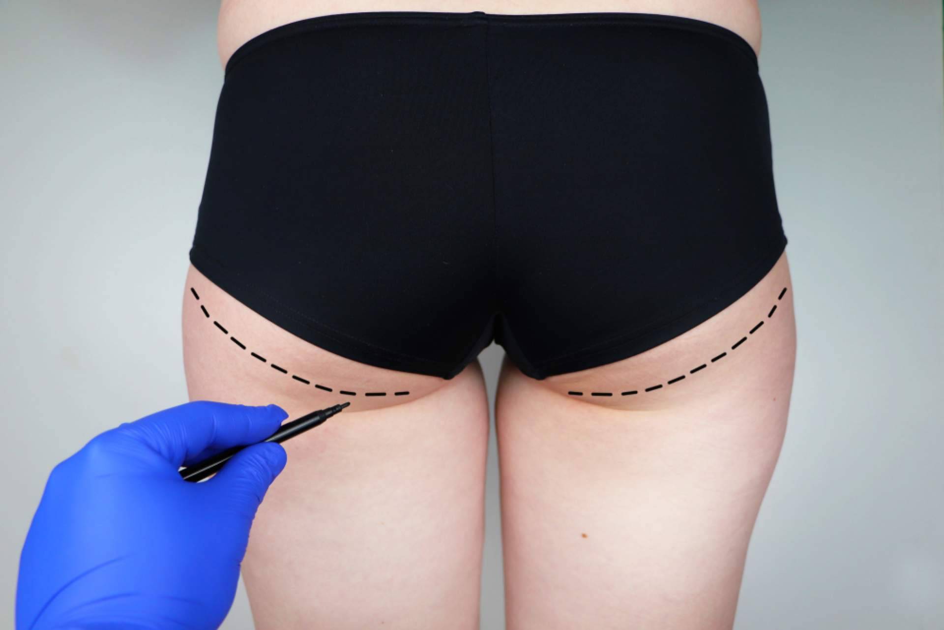 El Dr. Julián Castillo aplica técnicas avanzadas de gluteoplastia en Canarias