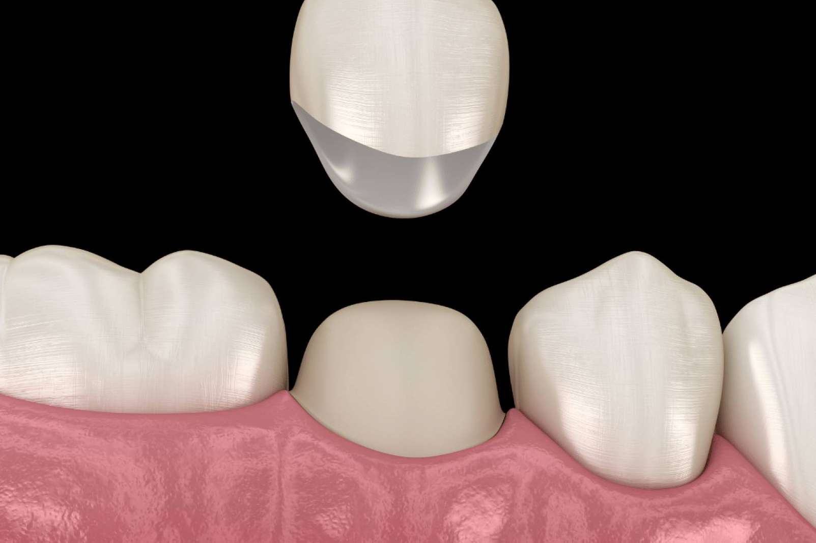 Coronas dentales, la solución estética y duradera para recuperar la sonrisa perfecta por la Clínica Dental Ruiz de Gopegui