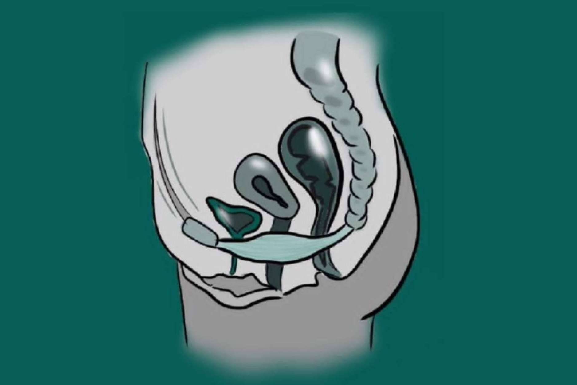 ¿Qué es un prolapso genital?, por el Dr. Nelson Díez