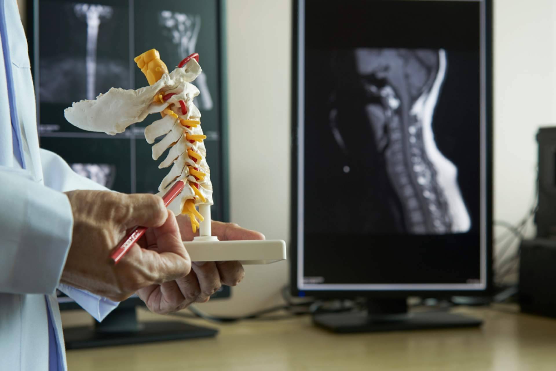¿Cuáles son las causas de la espondilolistesis?, por iXalud