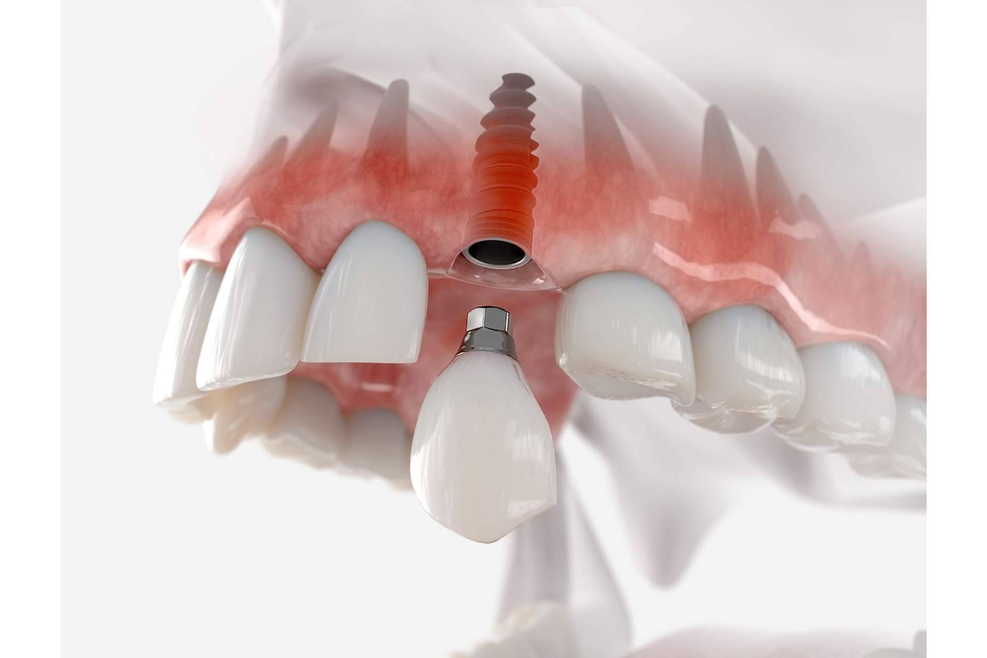 Los beneficios de un implante dental en DeltaDent