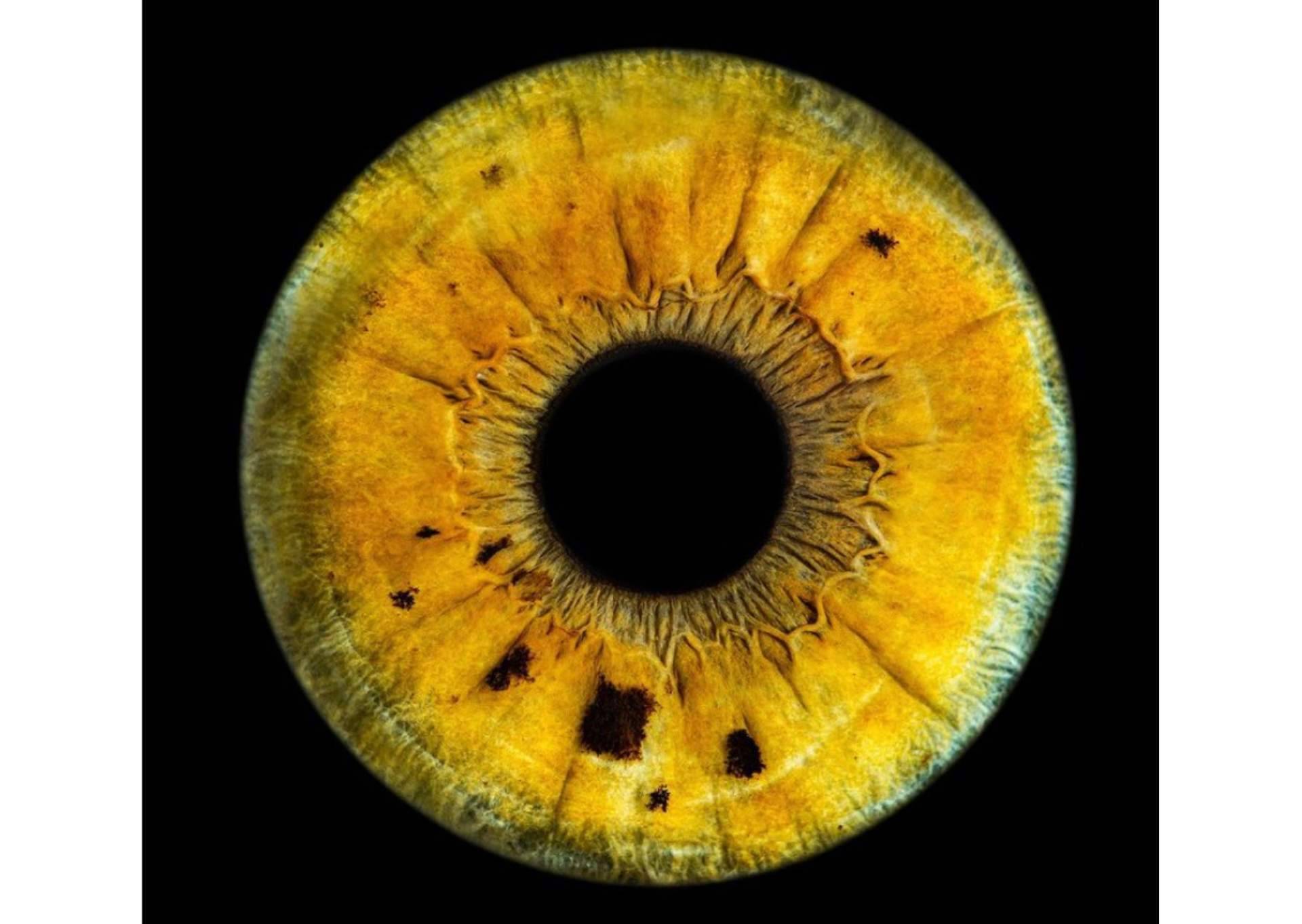 La clínica Eyecos advierte que las enfermedades metabólicas pueden cambiar el color de los ojos