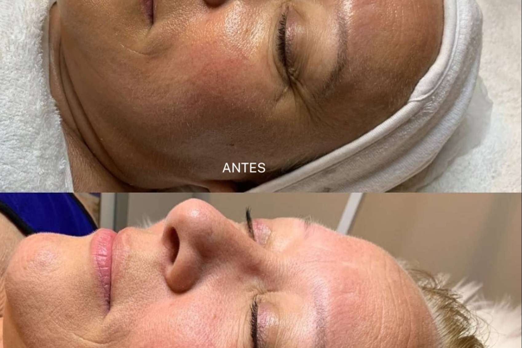 El Vortex Peel es uno de los mejores peelings de alta intensidad