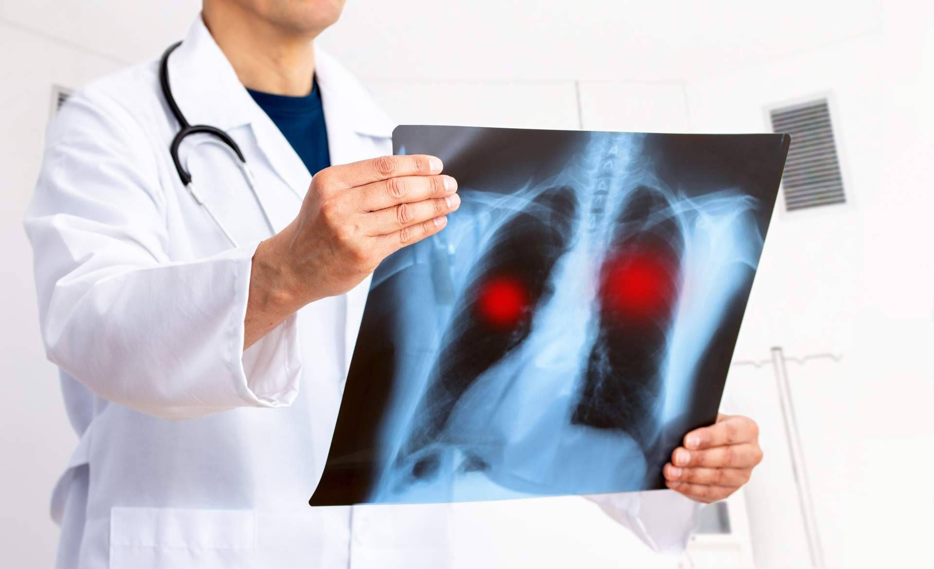 El tratamiento de cáncer de pulmón con Oncothermia (Nanothermia)