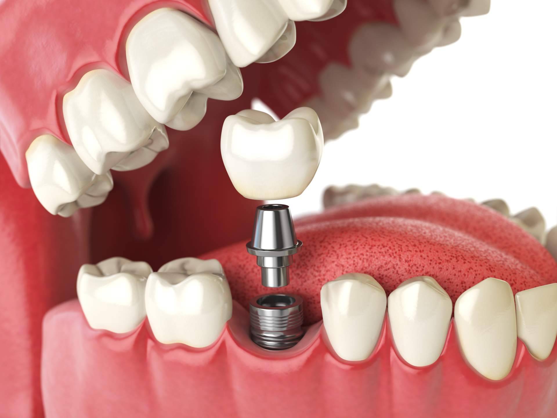 DeltaDent explica los beneficios de los implantes dentales