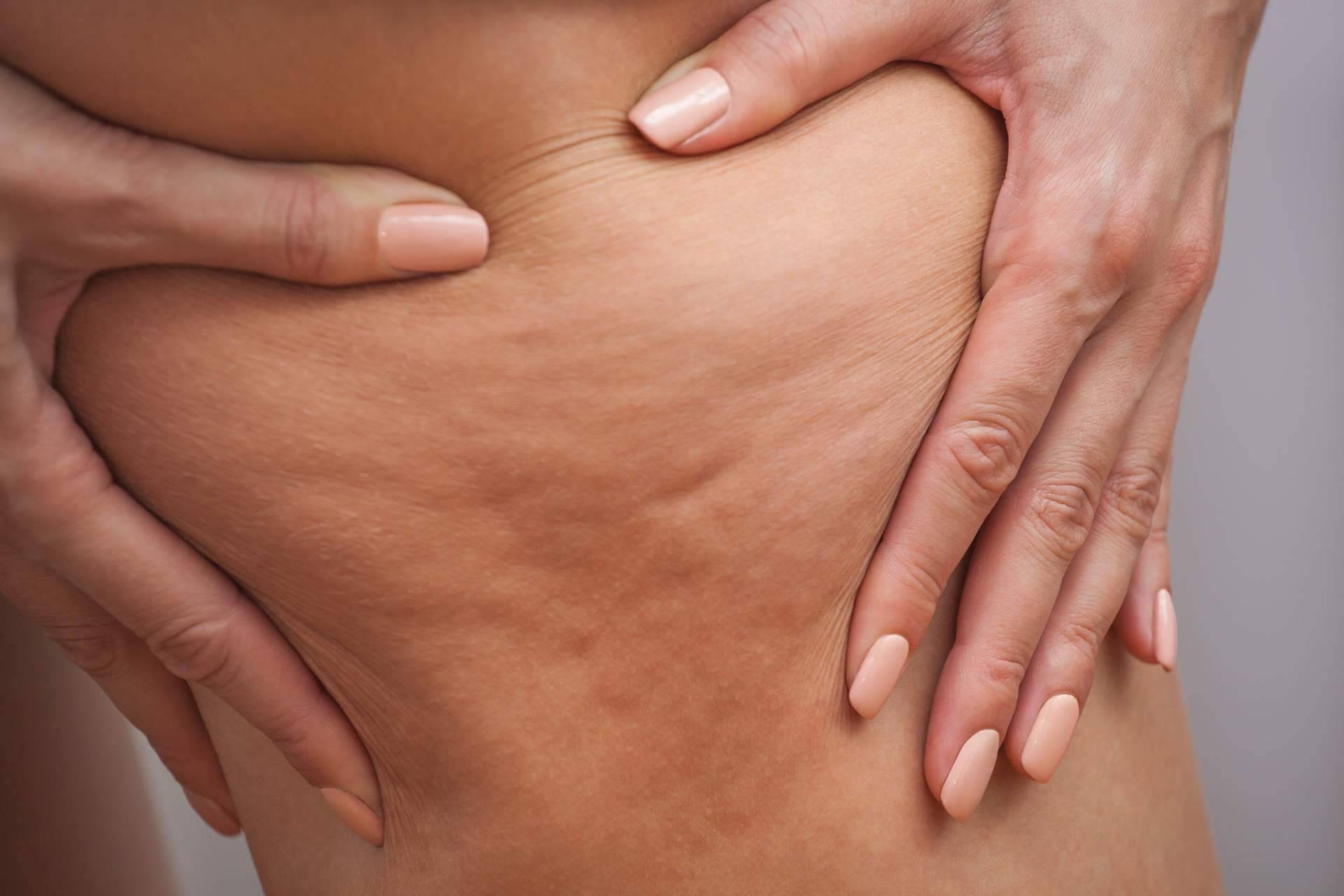 Tratamientos anticelulíticos saludables con Cuerpo Libre