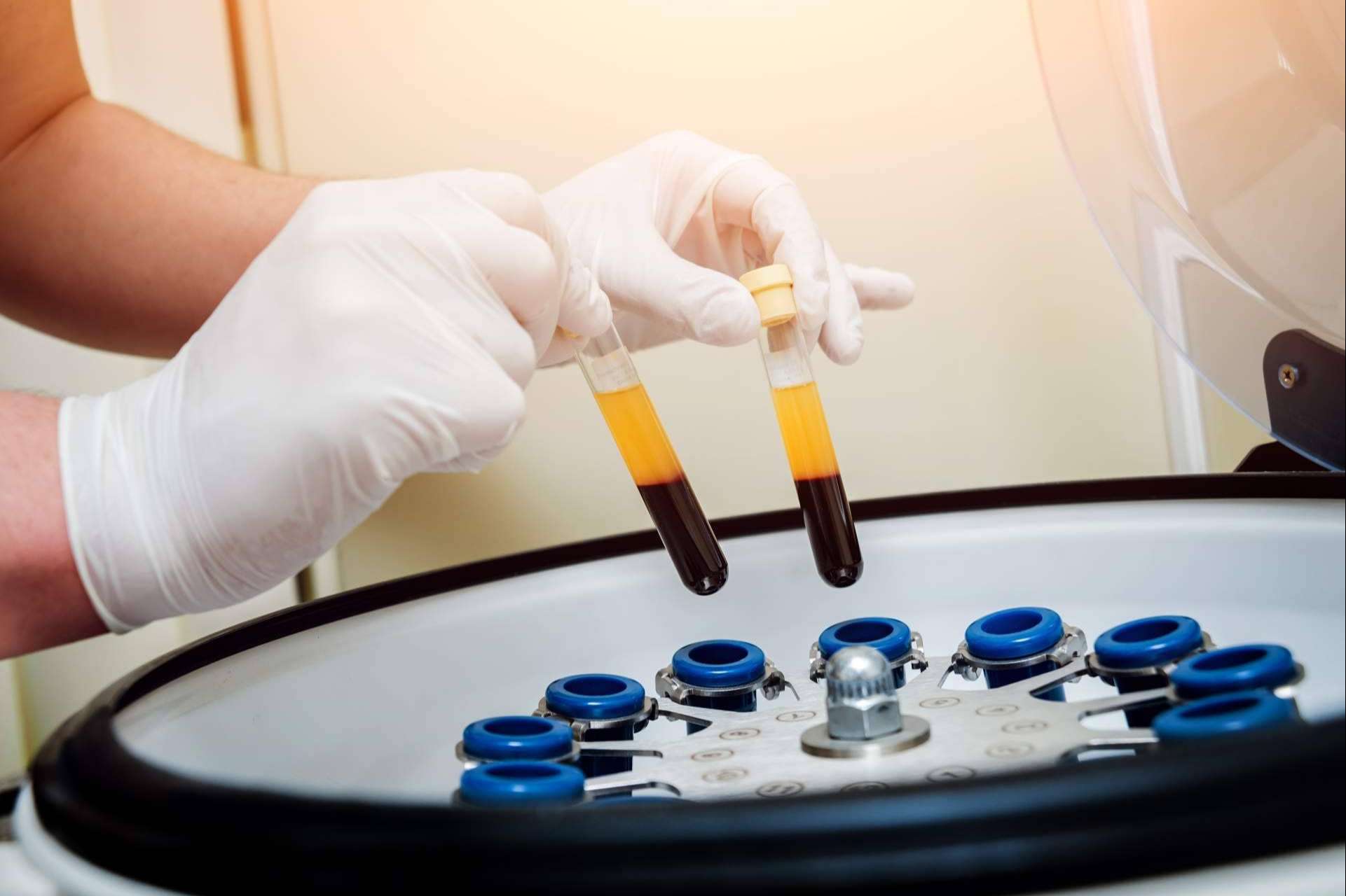 Centro Estética El Pilar y su innovador tratamiento de plasma rico en plaquetas