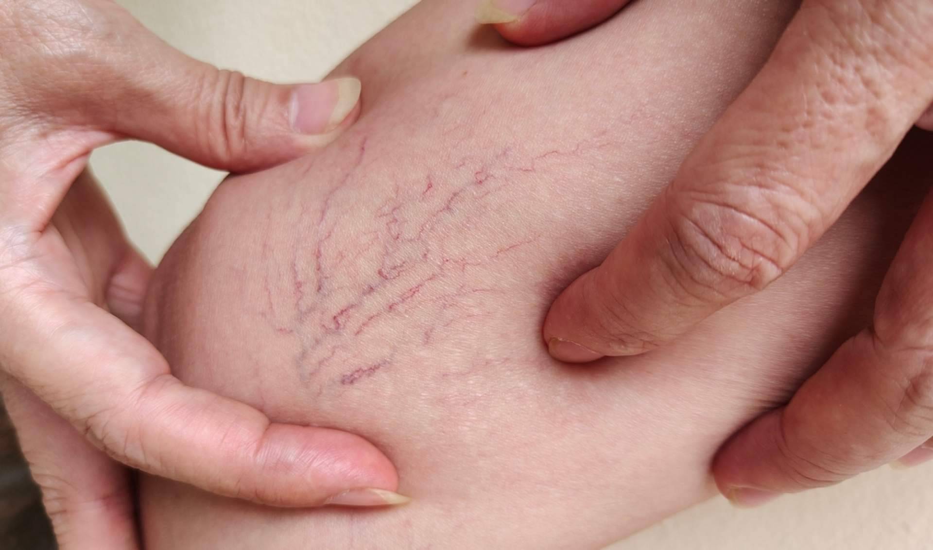 Los especialistas en la eliminación de varices de Elegansse
