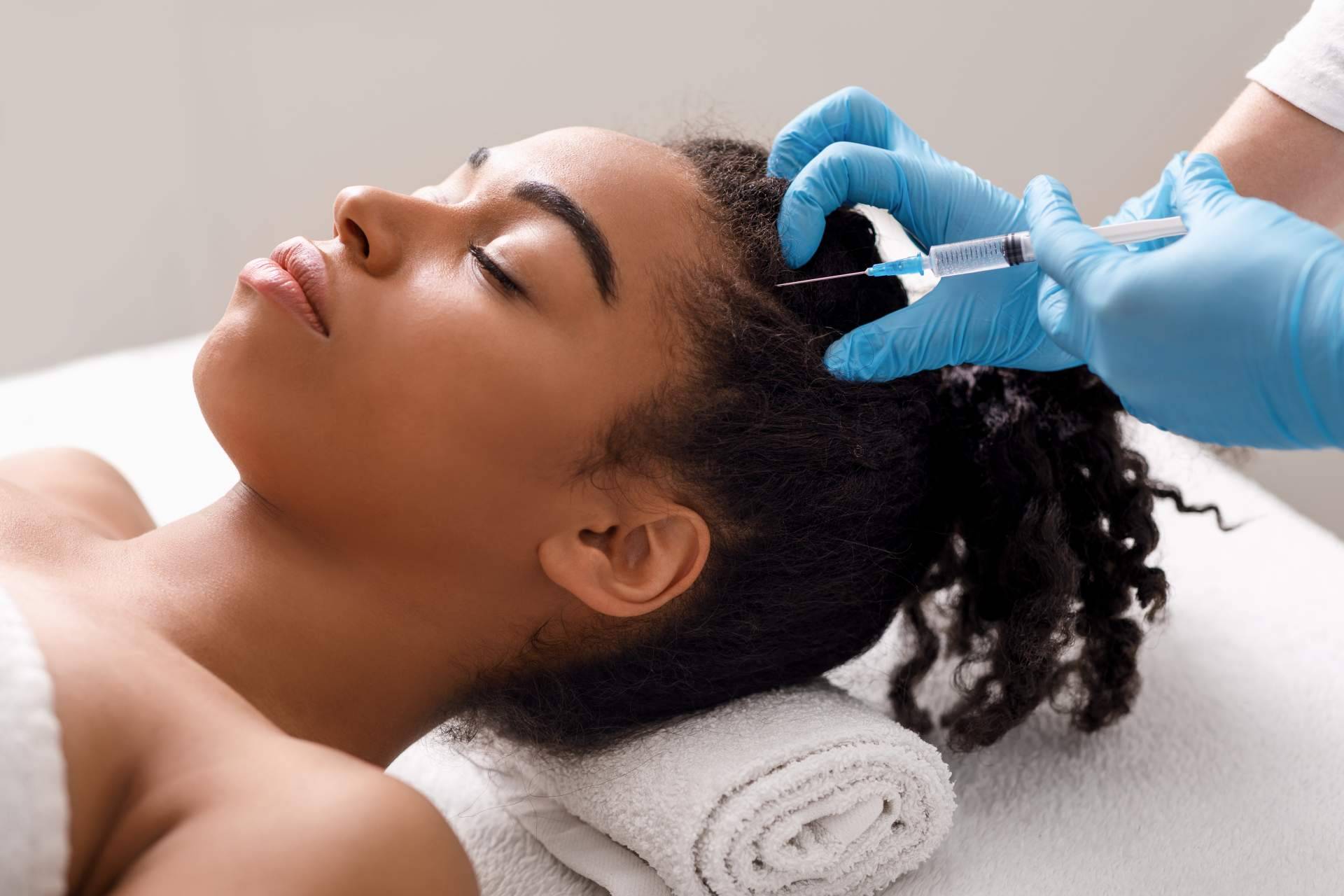 Tratamiento de la alopecia androgenética con exosomas, de la mano de Alluring Clinic