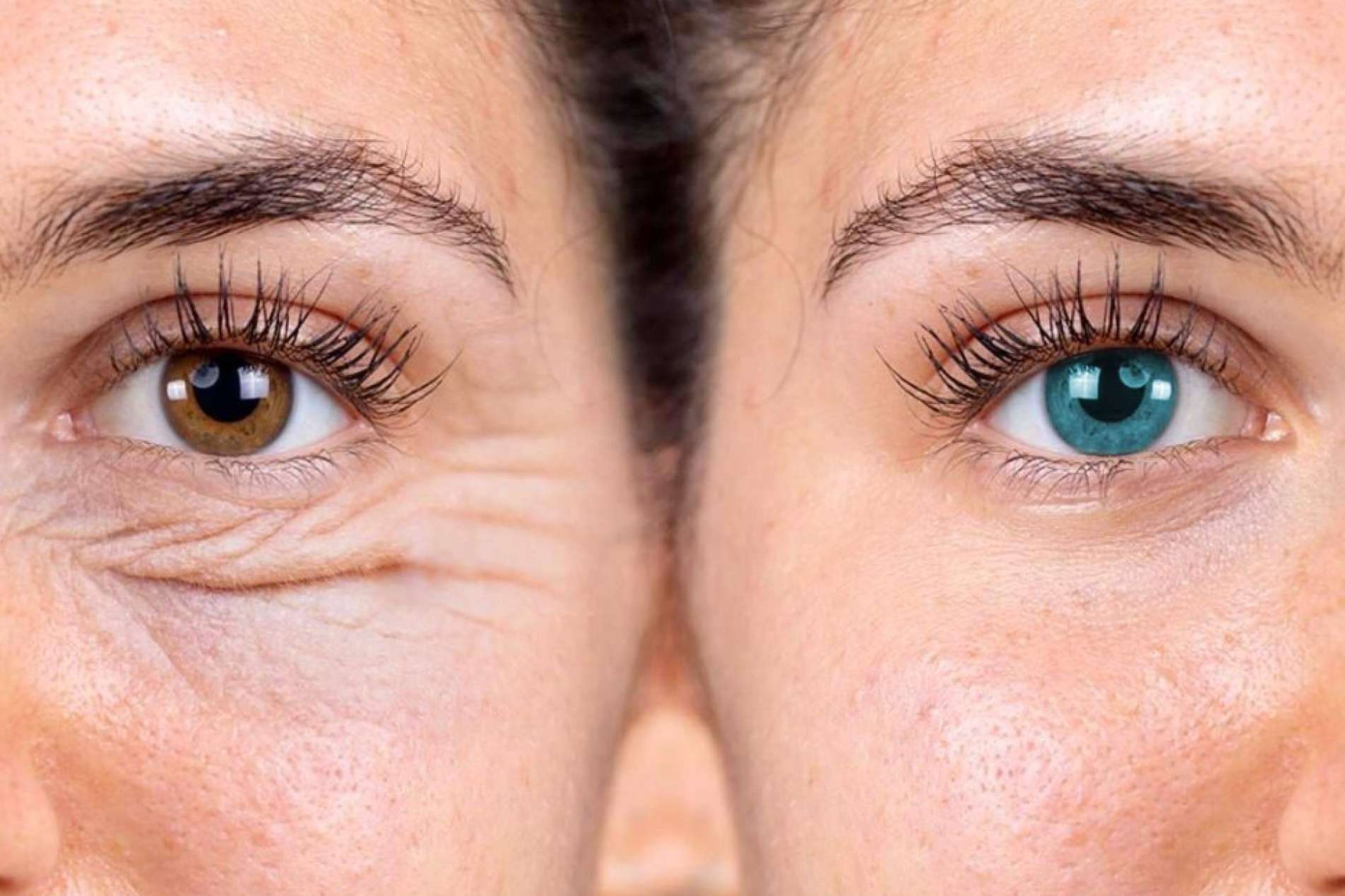 Blefaroplastia con láser sin cirugía, una opción saludable, poco invasiva y efectiva