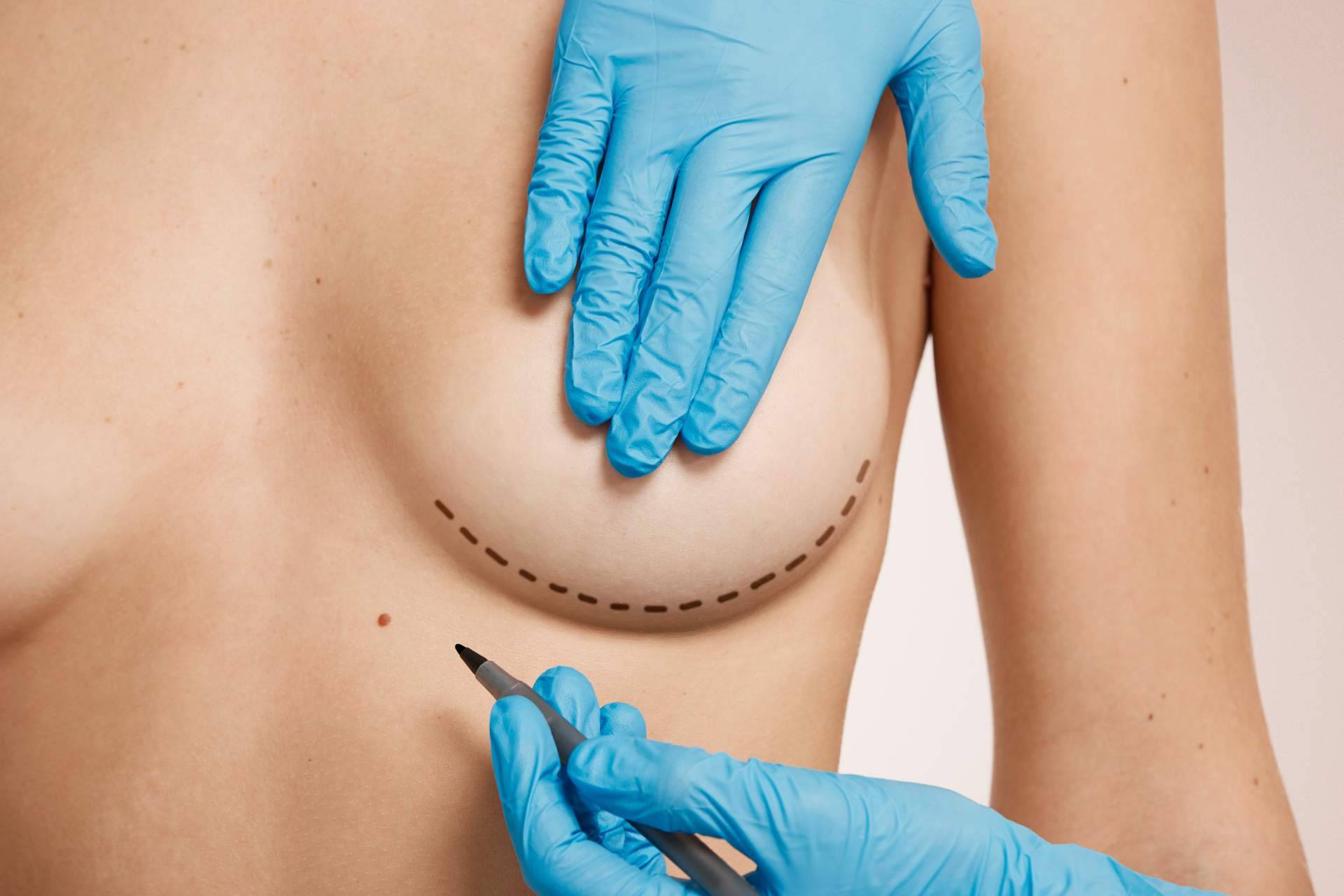 Beauty & Beauty realiza cirugías para la corrección de mamas tuberosas