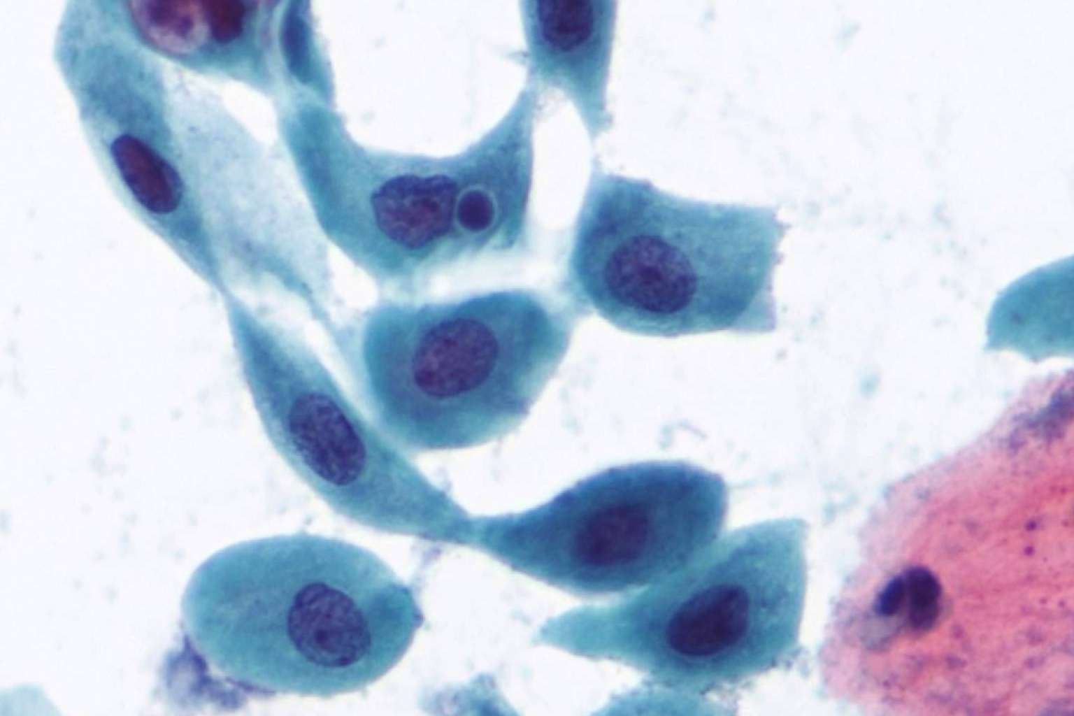 Nuevos servicios de diagnóstico del virus del papiloma humano en varones en CITOMOL