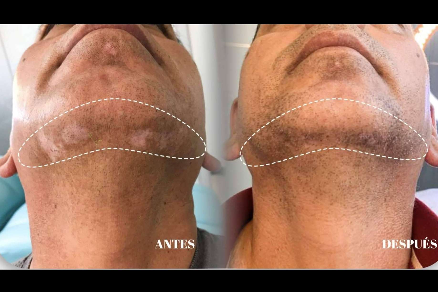 Terapia combinada para el vitiligo; el enfoque dermatológico de la Dra. Janeth Arévalo en Loja