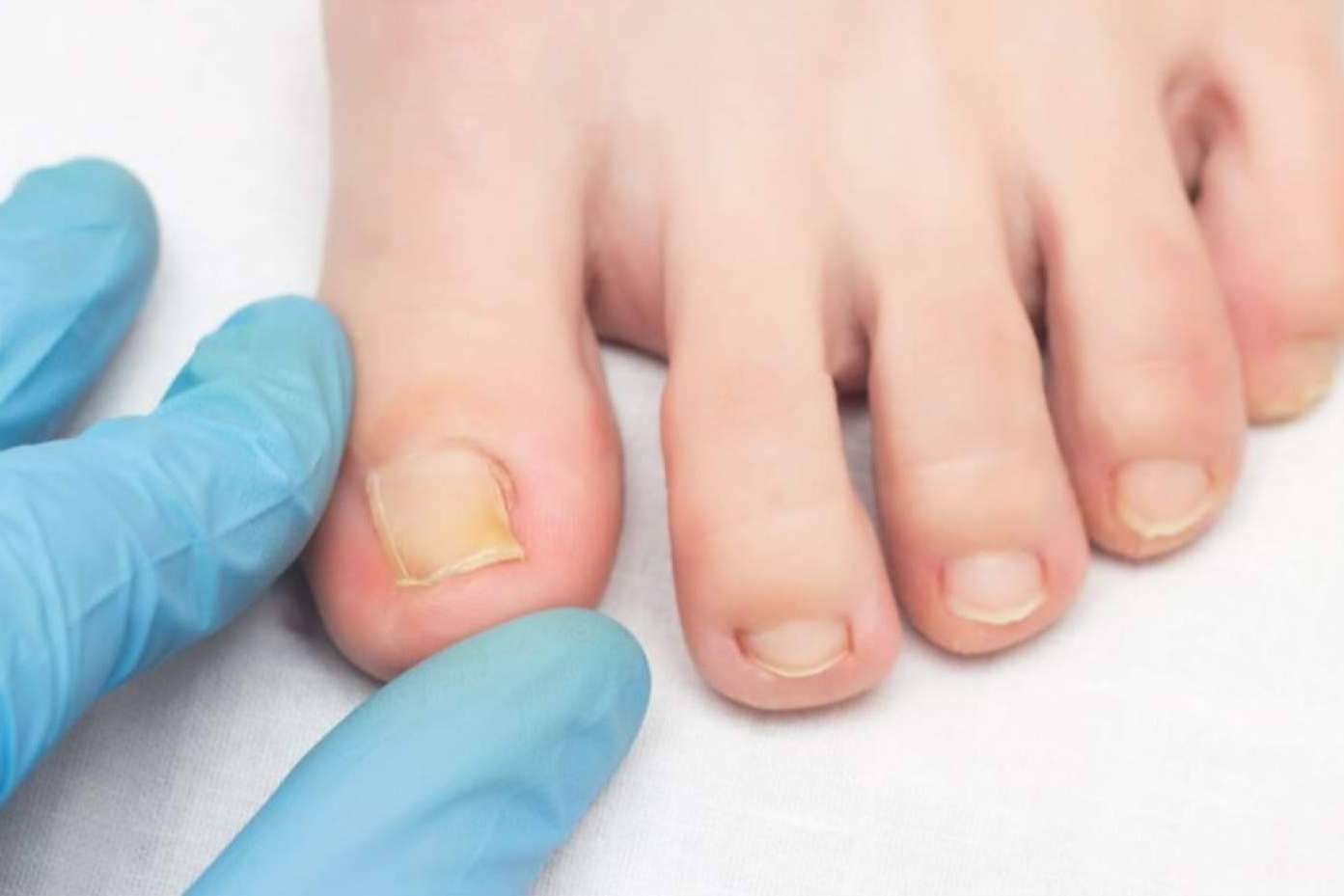 Piel limpia y protegida frente a micosis con Mycogel, de Laboratoires Bailleul