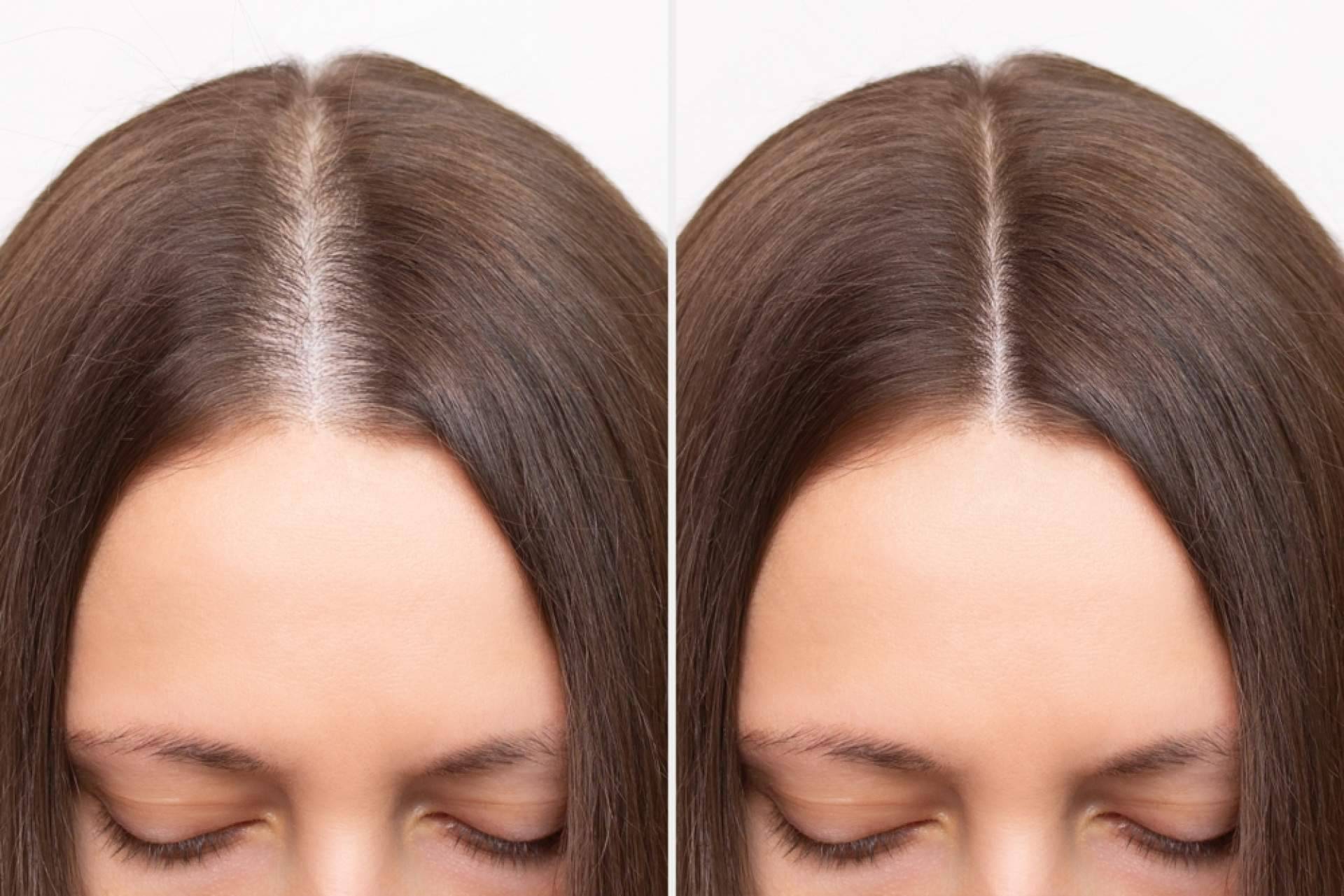 Estrés y cabello; el impacto emocional en la salud capilar