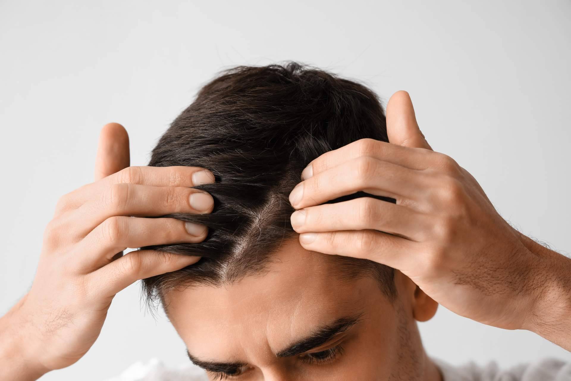 Xpecia Hombre combate la alopecia androgénica con una fórmula específica para frenar la caída del cabello