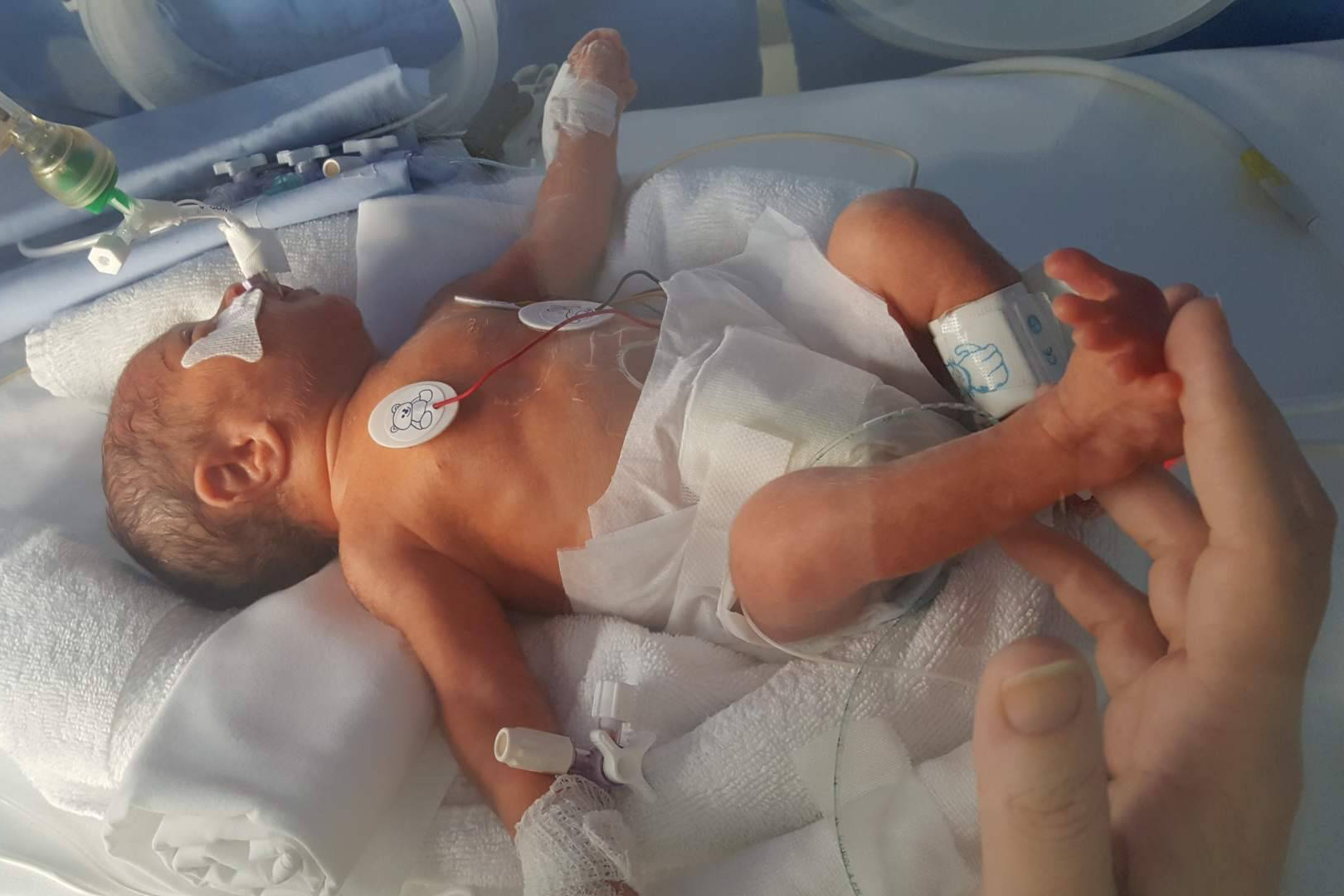 Día Mundial del Niño Prematuro; miles de familias españolas enfrentan retos que no se ven
